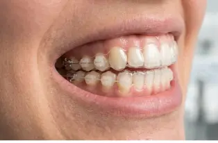 Hybrid aligner treatment